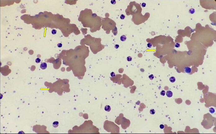 Hemolytic Anaemia