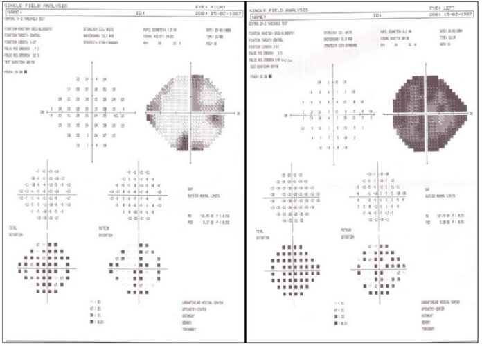 optic neuritis