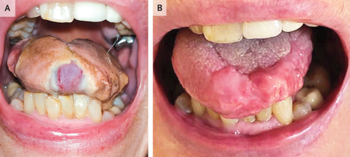 Tongue necrosis