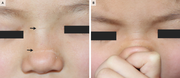 Transverse nasal creases