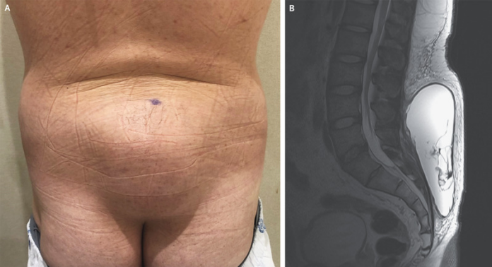 Morel–Lavallee Lesion