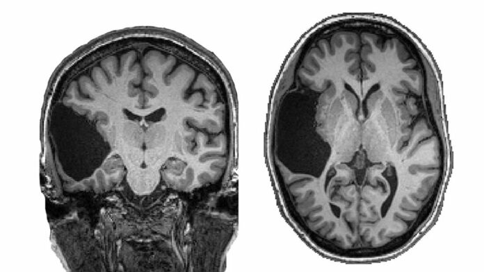 missing temporal lobe