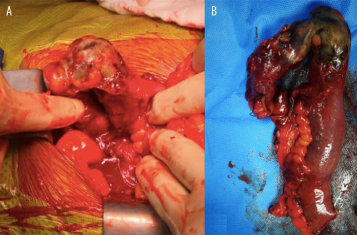 Duplicate inferior vena cava