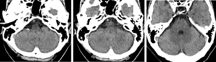 Basilar artery occlusion