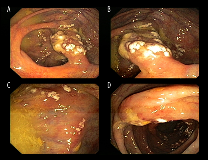 Colonic pseudolipomatosis