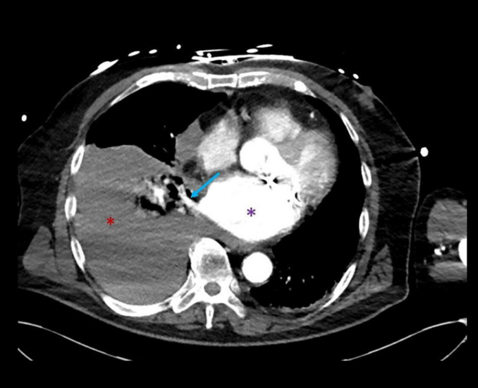 Hemothorax