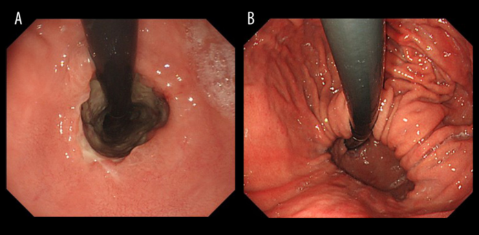 Refeeding syndrome induced cardiac arrest