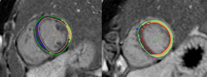 COVID-19 myocarditis