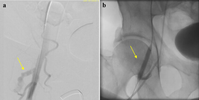 Impella