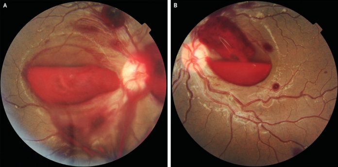 Retinal haemorrhage