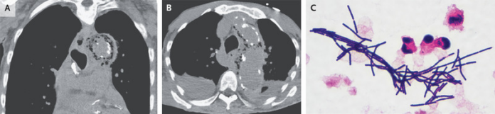 Emphysematous aortitis