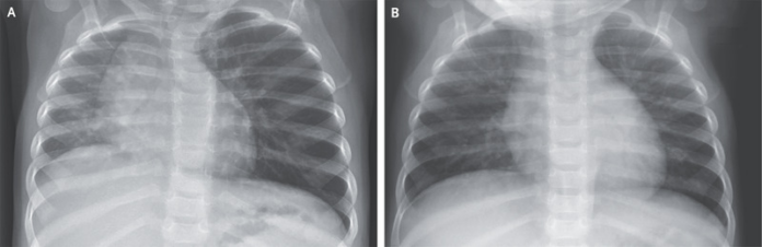 Case of Foreign Body Aspiration in a 12-Month-Old