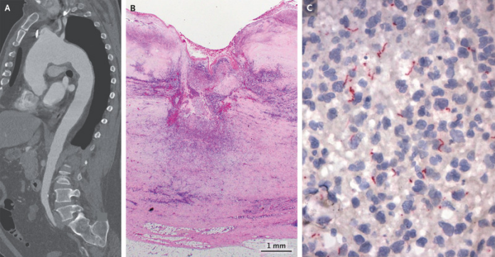 Aortitis