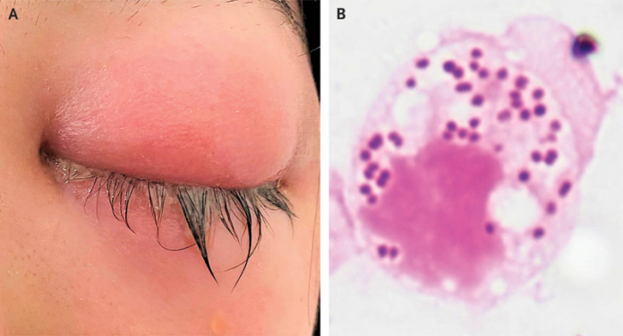 Occular Gonorrhea