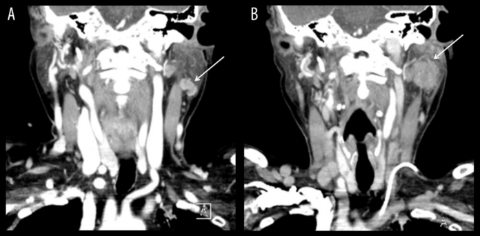 Breast cancer metastasis