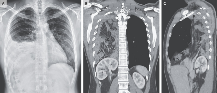 Congenital Diaphragmatic Hernia