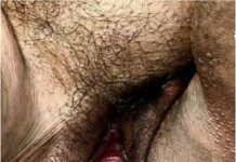 Proteus Syndrome in a 34-Year-Old: A Rare Case proteus