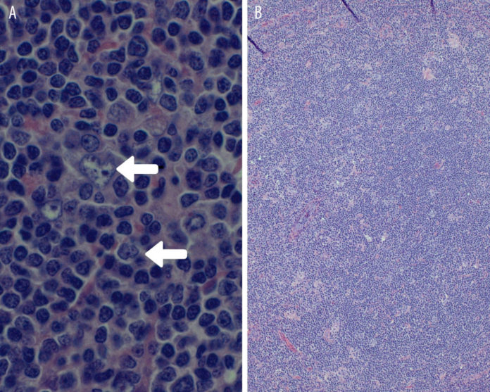 Hodgkin's Lymphoma