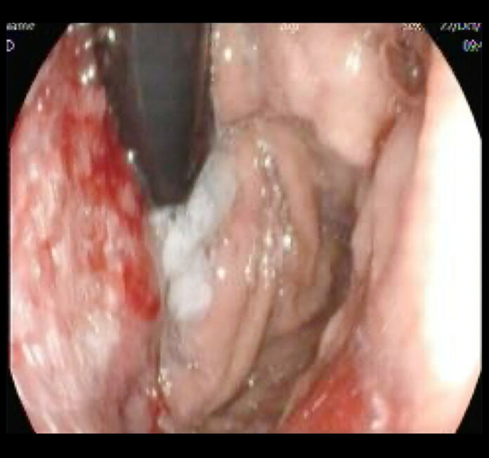 Metastatic Gastric Adenocarcinoma