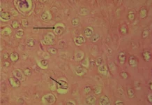 Buschke–Löwenstein in a Patient with HIV Buschke–Löwenstein