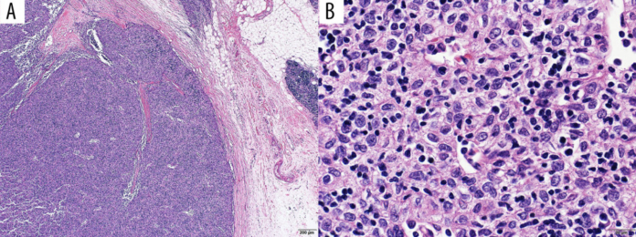 Myasthenia gravis