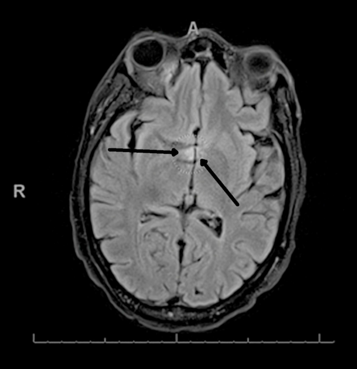 Neuromyelitis Optica