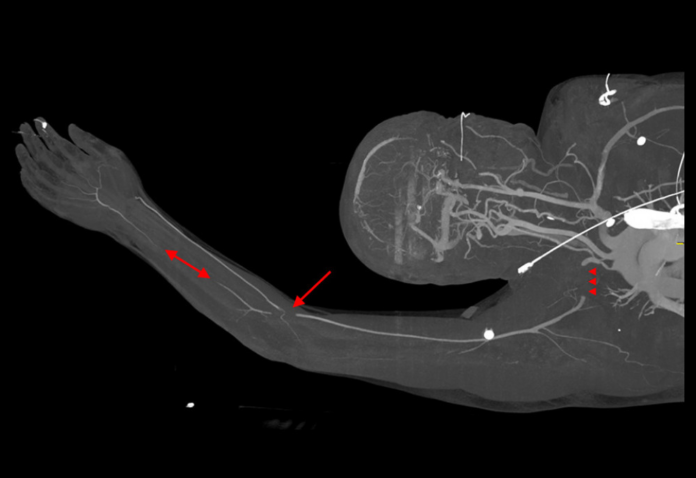 Cogan Syndrome, Acute Limb Ischemia