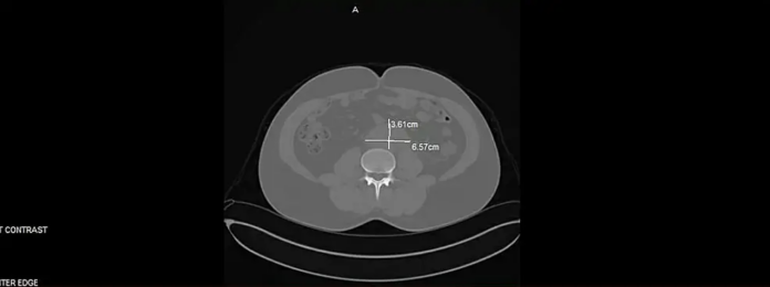 IgG4-related disease