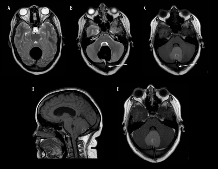 Intracranial dermoid cyst