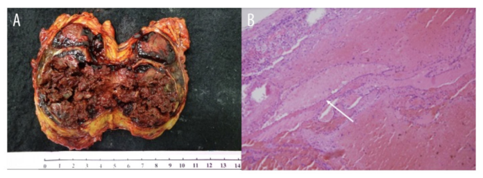 Adrenal Endothelial Cyst