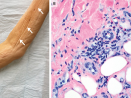 Eosinophilic Fasciitis