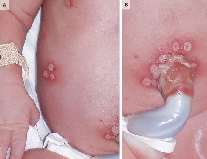 Neonatal herpes simplex virus infection