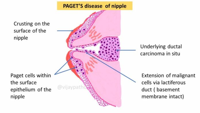 Paget's disease