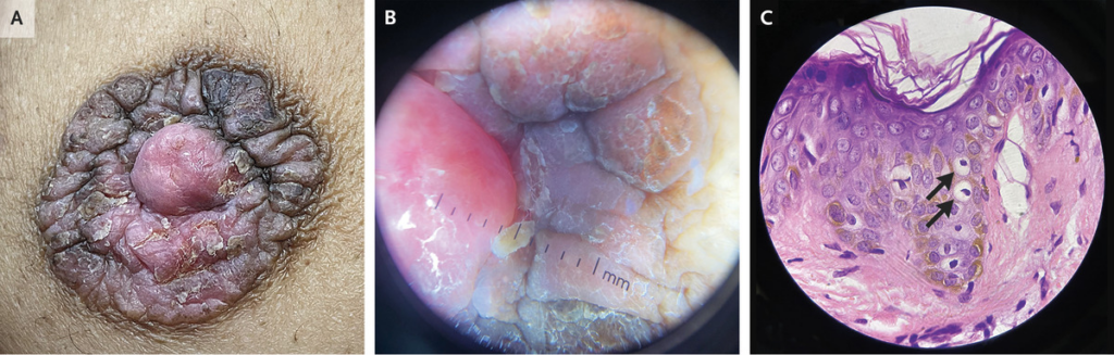 Paget's disease of the breast