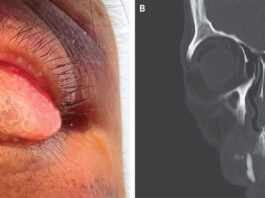 Orbital Emphysema
