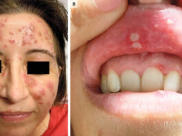 Papulopustular Rash in Behçet’s Disease