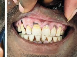 Lead poisoning