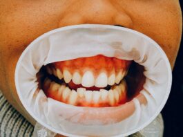 gingivitis