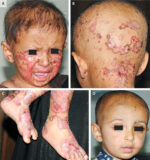Zinc Deficiency Rash Face Case of dietary zinc deficiency-associated dermatitis