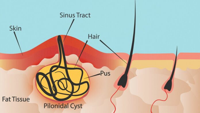 pilonidal disease