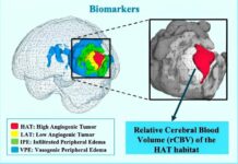 New Personalized Treatment for Glioblastoma Patients glioblastoma patients