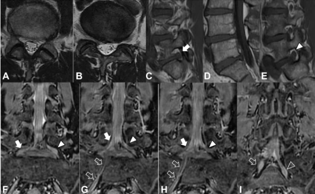 Conjoined Lumbosacral Nerve Root