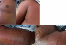 Sweet syndrome mimicking cellulitis Sweet syndrome