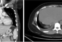Liver Resection for Liver Metastasis Secondary to Breast Cancer