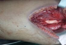 Hydatid Disease in Thigh Muscles: A Rare Case