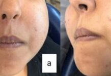 Oral Burkitt Lymphoma: A Case Report