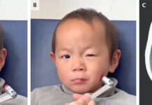 Case of Hypoparathyroidism and Chovtek’s Sign Chovtek's Sign