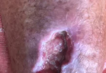 Infection with shewanella putrefaciens shewanella putrefaciens