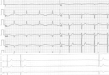 Missing P waves; A mystery atrial flutter