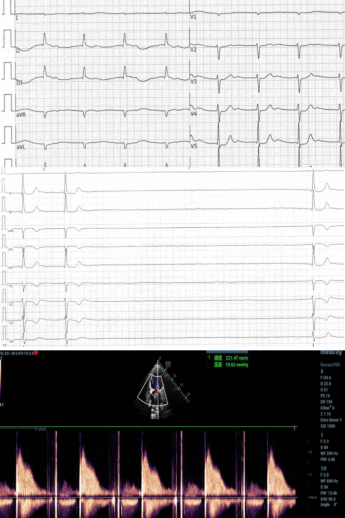 atrial flutter